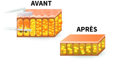 anti cellulite, traitement ultrason, réduire graisse, peau d'orange - Institut lot-et-Garonne 47, Aquitaine